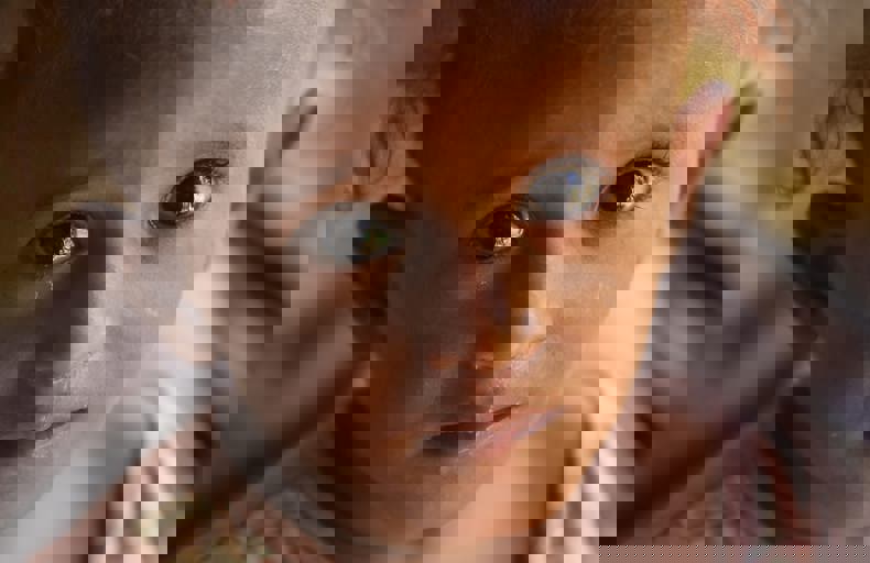 La malnutrition fait des ravages