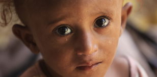 La Malnutrition au Yémen