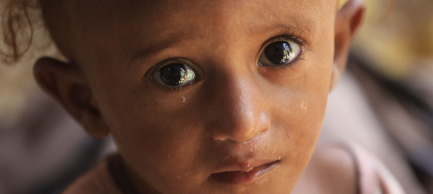 La Malnutrition au Yémen